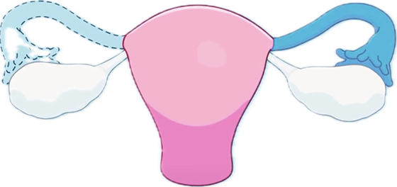 Salpingectomy